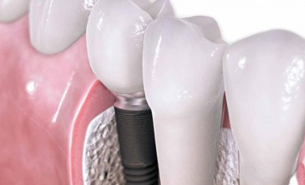 implantes-dental
